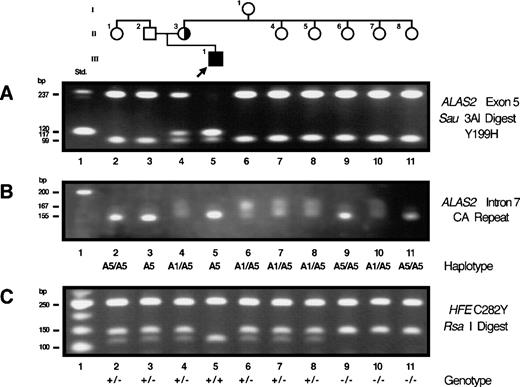 Fig. 3. Restriction analysis for confirmation of the exon 5 mutation, analysis of mutation origin, and genotype analysis for the C282Y HFE mutation in family 5. (A) Sau3AI restriction of exon 5 PCR products. (B) Polymorphic allele haplotype for the CA repeat in intron 7 of the ALAS2 gene. (C) RsaI restriction analysis of PCR products encompassing the C282 codon of theHFE gene.