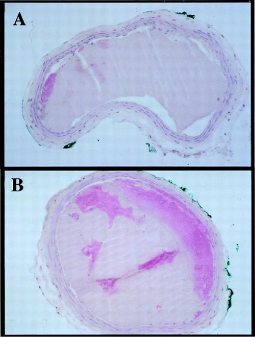 Fig. 2. Transverse sections of carotid arteries excised immediately after ferric chloride-induced thrombosis. (A) VN+/+ mouse. (B) VN −/− mouse. Thrombi consist of dense platelet aggregates (hematoxylin and eosin staining, original magnification × 200). The diameter of the mouse carotid artery is approximately 0.5 mm.