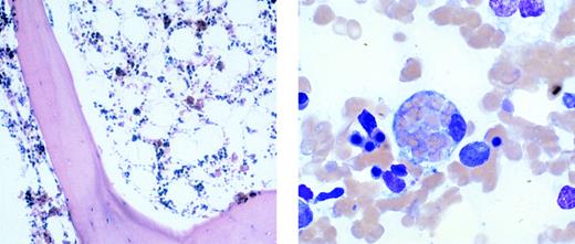 Virus-associated hemophagocytic syndrome. A healthy 18-year-old senior high school student presented with several weeks of myalgias, fevers, and sore throat. She subsequently developed pancytopenia and hepatic dysfunction. A thorough evaluation was unrevealing except for a positive monospot and Epstein-Barr virus (EBV) VCA-IgG with a negative EBV VCA-IgG and EBNA (both became positive several weeks later). A diagnosis of acute EBV infection was made. Over the next 3 weeks she had a waxing and waning course but finally required hospital admission due to worsening pancytopenia (WBC, 300/μL; hematocrit, 16.2%; and platelet count, 44,000/μL) and hepatic dysfunction (ALT, 636 U/L; AST, 608 U/L; LDH, 2,788 U/L; direct bilirubin, 32.2 mg/dL; and prothrombin time, 16 seconds). Her physical exam was notable for a fever (39.5°C), a diffuse fine scaly rash, severe icterus, no adenopathy, a liver span of 14 cm in the midclavicular line, and a spleen tip palpable 2 cm below the costal margin. Biopsy of her bone marrow showed overall hypocellularity with multiple nests of RBCs (arrows in figure on left; original magnification ×100). These nests of RBCs, as seen in the bone marrow aspirate (figure on right; original magnification ×2,500), represent histiocytes with engulfed erythrocytes characteristic of hemophagocytosis. Despite intense immunosuppressive therapy (including steroids, cyclosporin A, IVIG, and ATG), she developed respiratory failure, gastrointestinal bleeding, renal failure (requiring dialysis), cardiac dysfunction (with global hypokinesis), and pancreatitis. She finally succumbed to an intracranial hemorrhage. Virus-associated hemophagocytic syndrome is typically associated with acute EBV infection. It is characterized by constitutional symptoms, including fever, rash, lymphadenopathy, and hepatosplenomegaly. Therapy is directed at the immune dysregulation and is often ineffective, as in this unfortunate case. (Courtesy of Lindsey Baden, MD, and Frank Evangelista, MD, Beth Israel Deaconess Medical Center, Departments of Medicine and Pathology, 330 Brookline Ave, SL-435, Boston, MA 02215.)