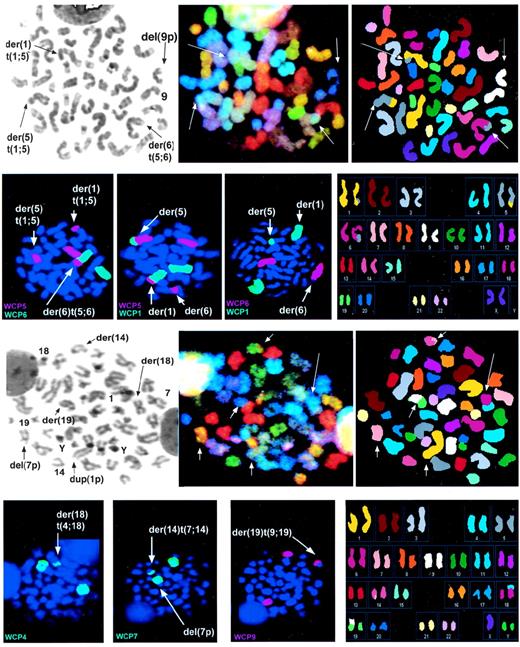 Fig. 1. Examples of the analysis of cells from 2 patients showing the DAPI, SKY, and classified images as well as the results using painting probes. (Top two rows, Case 1) (Left) Reverse DAPI image with the der(1), der(5), and der (6) chromosomes as well as normal 9 and del (9p) identified by arrows. (Middle) SKY image; (right) classified image. (Second row right) The classified karyotype of this cell. (Second row) Three panels show the results with painting probes for chromosomes 1, 5, and 6, confirming (left) that chromosome 5 material is on both the der(1) and der(6), (middle left) that the t(1;5) is reciprocal, and (middle right) that there is no material from chromosome 6 on either the der(1) or the der(5). (Bottom two rows, Case 3) (Left) Reverse DAPI image with the abnormal chromosomes including two Y chromosomes and dup(1p), del(7p), der(14), der(18), and der(19), are identified by arrows. (Middle) SKY image of same cell; (right) classified image. (Bottom row right) Classified karyotype. (Bottom row) Three panels showing the results of painting probes for chromosomes 4, 7, and 9, confirming (left) that part of chromosome 4 is on the der(18), (middle left) that part of 7, presumably 7p, is on the der(14), and (middle right) that part of 9 is on the der(19).