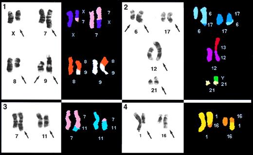 Fig. 2. Partial karyotypes of cells with rearranged chromosomes; the involved chromosomes from the G-banded karyotype on the left and the classified images on the right. The chromosome origin of the classified image is listed for each chromosome. In panel 1, note that for Case 4, the left chromosome 9 has a deletion of the p arm. Panel 2 is Case 2, panel 3 is Case 6, and panel 4 is Case 5.