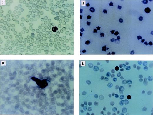 Fig. 2. Proliferative disorders in LN-ras2 reconstituted mice. (A) LK8 spleen section. Normal splenic architecture, follicular organization of the lymphoid cells, marginal zones, and red pulp composed of erythroid cells are shown. (B) Nr9 spleen section. The splenic architecture is disrupted by darkly stained hematopoietic cells (arrow). (C) Nr18 spleen section. Large foci of myelomonocytic cells that obliterate the normal splenic architecture (light staining) are shown. (D) Nr17 spleen section. Sheets of abnormal mast cells (light staining) that have disrupted the normal splenic architecture are shown. (E) LK8 spleen cells. Normal splenocytes, large and small lymphocytes, myeloid cells, and erythroid progenitor cells are shown. (F) Nr9 spleen cells. Abundant erythroid progenitors (arrows) are shown. (G) Nr16 spleen cells. Increased numbers of large monocytes (X) and myeloid cells (arrow) are shown. (H) Nr17 spleen cells. Darkly granulated mast cells (X) and increased numbers of erythroid progenitors (arrows) are shown. (I) LK8 blood. Normal erythrocytes and a neutrophilic granulocyte are shown. (J) Nr9 blood. Polychromatic and spiculated erythrocytes are demonstrated. (K) Nr18 blood. Two abnormal myelomonocytic cells are shown. (L) Blood from Nr17. Aberrant erythrocytes are shown. Histologic sections (A through D) were stained with hematoxylin and eosin (original magnification ×50). Cytospun preparations (E through H) and blood smears (I through L) were stained with May-Grunwald and Giemsa (original magnification ×500).