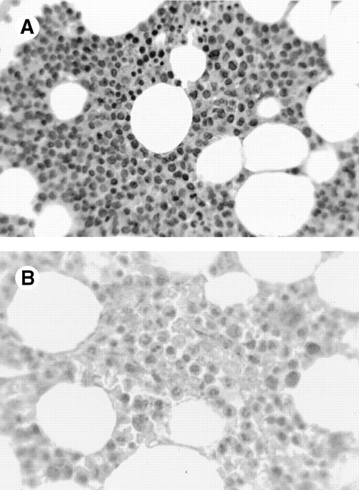 Fig. 1. Immunohistochemistry showing cyclin A1 expression in tissue sections. (A) Bone marrow biopsy from a case of acute promyelocytic leukemia (AML M3). Promyelocytes show strong nuclear staining for cyclin A1. (B) Normal bone marrow biopsy with negative or focal weak staining of myeloid precursors. (C) Adenocarcinoma of the colon with malignant cells showing nuclear staining for cyclin A1 (arrowheads). Hematoxylin counterstain original magnification × 400.