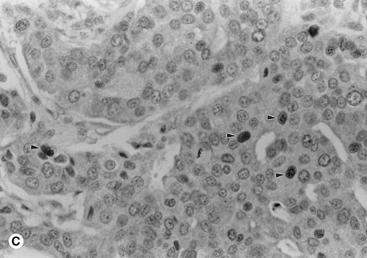 Fig. 1. Immunohistochemistry showing cyclin A1 expression in tissue sections. (A) Bone marrow biopsy from a case of acute promyelocytic leukemia (AML M3). Promyelocytes show strong nuclear staining for cyclin A1. (B) Normal bone marrow biopsy with negative or focal weak staining of myeloid precursors. (C) Adenocarcinoma of the colon with malignant cells showing nuclear staining for cyclin A1 (arrowheads). Hematoxylin counterstain original magnification × 400.
