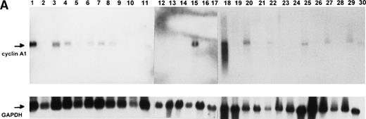 Fig. 2. Northern blot and immunoblot showing cyclin A1 expression in leukemia samples. (A) Northern blot showing the expression of cyclin A1 in leukemia samples. Lanes 26 and 27 are NB4 and U937 cell lines, respectively. (B) Immunoblot show cyclin A1 protein level in leukemia samples. The diagnostic information for each lane of the Northern blot and immunoblot is summarized in Table 2.