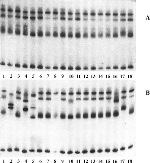 Fig. 3. PCR-SSCP analysis of the 5′ noncoding region E1.11 of the Bcl6 gene in a reactive tonsil. Abnormal SSCP bands were shown in clones 1, 2, 4, 5, 10, 16, and 17 from follicular center cell (B), but in none from mantle cell (A) populations.