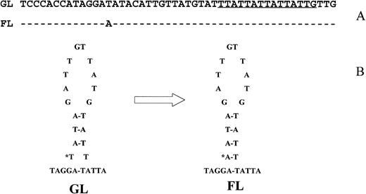 Fig. 4. A T > A mutation in a follicular lymphoma (FL). The proximity of the mutation to a (TTA)n repeat sequence (underlined) and its localization to the stem of an imperfect hairpin structure in the germline (GL) sequence were shown in (A) and (B), respectively.