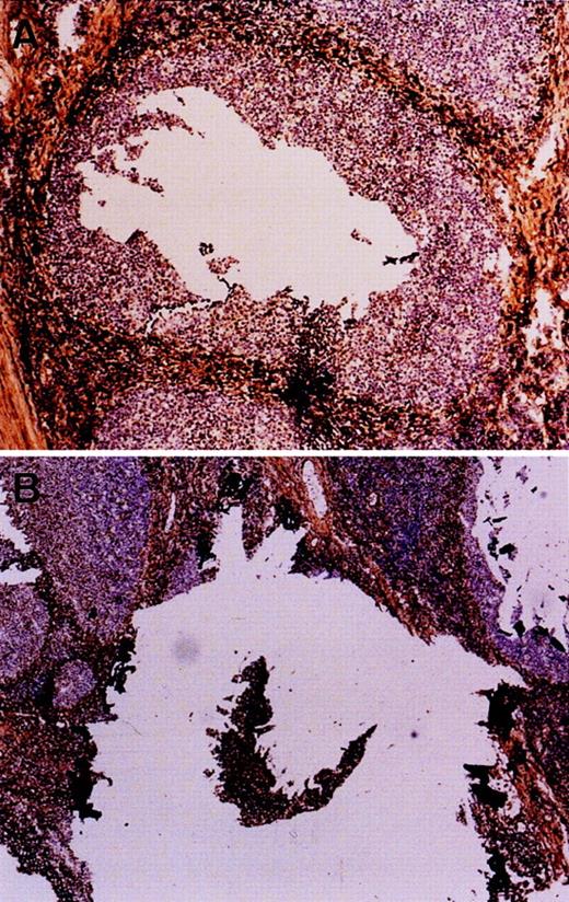 Fig. 1. Microdissection of germinal center (A) and naive B cells (B) of the mantle zone. Frozen sections of a tonsil were immuno-stained for IgD to highlight mantle cells. Germinal center cells were directly microdissected (the hole), whereas mantle cells were first isolated (the island) then harvested.