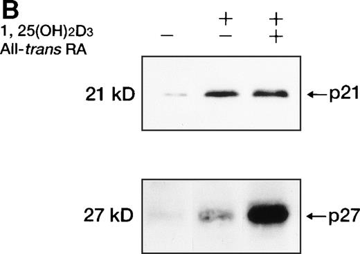 Fig. 8. Western blot analysis of p21WAF1/CIP1and p27KIP1 protein. (A) Total cellular protein (10 μg per lane) from UF-1 cells treated for 3-72 hours with 10−7 mol/L 1,25(OH)2D3 was separated on a 12.5% SDS-polyacrylamide gel and transferred to the membrane. p21WAF1/CIP1 and p27KIP1 protein levels were detected by Western blotting using antibodies directed against p21WAF1/CIP1 and p27KIP1, and then the blots were stained with Coomassie brilliant blue to confirm that equal amounts of protein were present in each lane. (B) Enhanced expression of p27KIP1 protein by exposure of cells to the combination of 10−7 mol/L all-trans RA and 1,25(OH)2D3 for 48 hours.