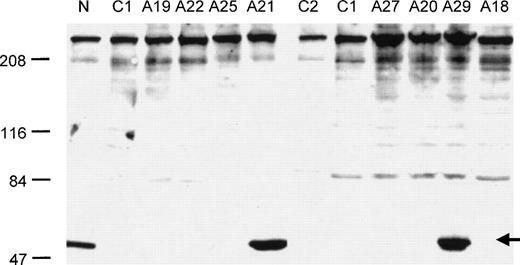 Fig. 4. Western blot analysis of ERGIC-53 protein levels in selected families with F5F8D (see Table 1 for the nature of the ERGIC-53 mutation present in each affected individual). N indicates a normal control, lanes C1 and C2 are two different mutations from reference 1 (C1: 86-89insG; C2 IVS9 + 2 T > C). The arrow indicates the position of the ERGIC-53 protein band. Normal levels of ERGIC-53 protein were also found in two unaffected family members from family A19.