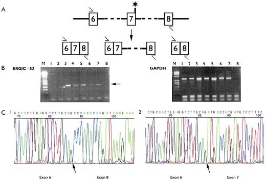 Fig. 3. (A) Cartoon representation of intron 6-intron 8 of the ERGIC-53 gene. The primers used for the RT-PCR analysis are indicated by an arrow and the asterisk indicates the position of the IVS7-1 mutation. Potential RT-PCR products resulting from normal splicing, inclusion of intron 7 or skipping of exon 7 are shown. (B) Agarose gel electrophoresis of the RT-PCR products after amplification of polyadenylated RNA with ERGIC-53 exon 6-exon 8 specific primers and glyceraldehyde 3-phosphate dehydrogenase (GAPDH) specific primers. The GAPDH amplification was a control for mRNA integrity. The cDNA synthesis was primed with the exon 8 specific primer and oligo dT. Lane M, markers; lane 1, individual A2 (homozygous 822G > A); lane 2, individual A12 (homozygous 822G > A); lane 3, human endothelial cell line; lane 4, unaffected individual; lanes 5, 6, and 7, affected individuals with the M1T mutation; lane 8, no DNA control. The arrow marks the normally spliced product. The asterisk marks the incorrectly spliced product. (C) DNA sequence chromatograms of: 1, the incorrectly spliced product, resulting from skipping of exon 7, observed in RT-PCR of polyadenylated lymphoblastoid RNA from individual A12; 2, the major product observed in RT-PCR of polyadenylated RNA from a human endothelial cell line. The exon boundaries are indicated by an arrow.