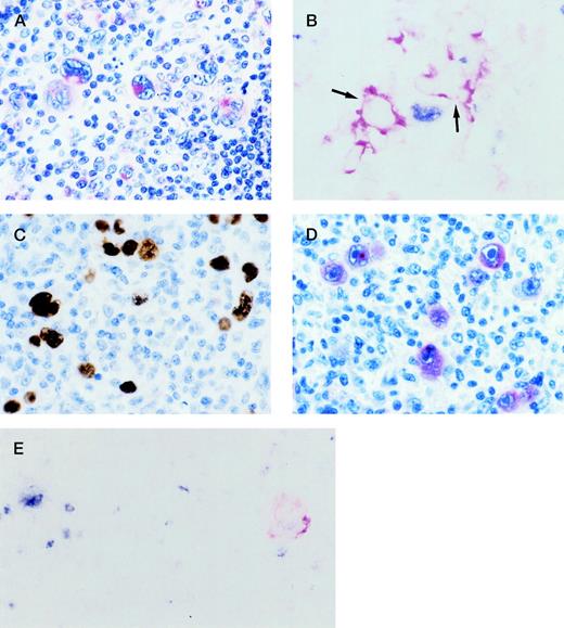 Fig. 1. (A) HIV-HD NS subtype (case 26). RS cells show cytoplasmic and membranous staining of variable intensity for CD138/syn-1 in Bouin-fixed, paraffin-embedded tissue section. (B) HIV-HD MC subtype (case 6). A frozen section was tested by 2-color staining with BCL-6 MoAb and syn-1 MoAb. A BCL-6+(nuclear, blue) RS cell and syn-1+ (cytoplasmic and membranous, red) RS cells (arrows) are present. No coexpression of BCL-6 protein is detectable in syn-1+ RS cells. (C, D) HIV-HD LD subtype (case 25). (C) RS cells show EBV positivity by EBER in situ hybridization. Signal is present as dense brownish grains over the nuclei of RS cells. (D) Most RS cells display strong cytoplasmic staining for the EBV-encoded LMP1. (E) HIV-HD MC subtype (case 14). A frozen section was tested by 2-color staining with BCL-6 MoAb and LMP1 MoAb. An RS cell exhibits nuclear staining (blue) for BCL-6 (at left), whereas another RS cell shows cytoplasmic and membranous staining (reddish) for LMP1 (at right). No coexpression of both markers by the same tumor cell is detectable. (A, D) APAAP immunostaining, hematoxylin counterstain; (B, E) 2-color staining, no counterstain; (C) in situ hybridization, hematoxylin counterstain. Original magnification ×250, A-E.