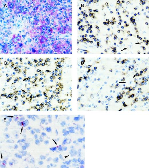 Fig. 2. (A) HIV-HD LD subtype (case 25). Most RS cells show a distinct pattern of staining for anti-CD40 MoAb 89: a strong membranous staining is associated with a dot-like cytoplasmic positivity in Bouin-fixed, paraffin-embedded tissue section. (B, C, D) HIV-HD MC subtype (case 9). Serial Bouin-fixed, paraffin-embedded sections show that in the same area containing RS cells (arrows), numerous CD3+ (B) and CD8+ (C) small lymphocytes are present in the cellular background, where cells positive for CD4 (D) are scarce. (E) HIV-HD MC subtype (case 1). CD40L positivity is manifested on frozen section as dot-like staining on scattered lymphocytes (arrows). An RS cell surrounded by CD40L−lymphocytes is also shown (arrowhead). (A, E) APAAP immunostaining; (B, C, D) ABC immunostaining; (A-E) hematoxylin counterstain. Original magnification ×250 (A), ×320 (B-D), and ×400 (E).