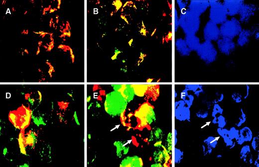 Fig. 4. TNF- induced cytochrome c release from mitochondria. CEM cells (A through C) and CEM/VLB100 cells (D through F) were incubated with or without 250 U/mL TNF- for 3 hours, labeled with MitoTracker, fixed, permeabilized, stained with native anti-cytochrome c antibody, and finally counterstained with DAPI as described in Materials and Methods. The stained cells were examined by fluorescence microscopy. Cytochrome c antibody was visualized with a fluorescent-conjugated anti-mouse IgG and assigned the color green, whereas mitochondria labeled with MitoTracker were assigned the color red. In the control cells (A and D) and CEM cells treated with TNF- for 3 hours (B), red and green images were merged; overlapping red and green pixels appears orange/yellow. CEM/VLB100 cells treated with TNF- for 3 hours displayed separation of the green (cytochrome c) from the mitochondria (red) with appearance in the cytosol (E and F). C and F are cells similar to B and E but counterstained with the nuclear dye DAPI. Cells with condensed and/or fragmented nuclei are apoptotic cells (arrows).