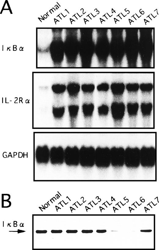 Fig. 5. Expression of IκB at mRNA (A) and protein (B) levels in primary leukemic cells from ATL patients and normal healthy subjects. (A) Total RNA was extracted from PBMC and assessed for IκB, IL-2R, or GAPDH mRNA expression. A representative Northern blot is shown from patients with ATL and healthy subjects (normal). (B) PBMC obtained from patients with ATL or healthy subjects (normal) were assessed for IκB by Western blot analysis.
