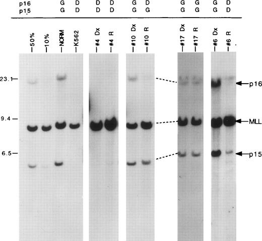 Fig. 1. p16/p15 deletions in matched diagnostic and relapse ALL specimen pairs. Autoradiogram of a blot containingBamH1-digested DNAs cohybridized with p16 and MLLcDNA probes. The locations of the germline p16,p15, and MLL bands are indicated by arrows at right. The migration of molecular size markers are shown in kilobases on the left. Samples include DNA from dilutions of the K562 cell line, which has homozygous p16 and p15 deletions, into normal DNA to simulate deletions in 50% and 10% of the cell population; a healthy control (NORM); K562; and four matched diagnostic (Dx) and relapse (R) patient samples (no. 4, 10, 17, 6). The gene status ofp16 and p15 is listed above each patient sample (G, germline; D, deleted). Faint residual p16 and p15 bands (<10%) in no. 6 relapse patient sample are due to contamination with small amounts of normal cells.