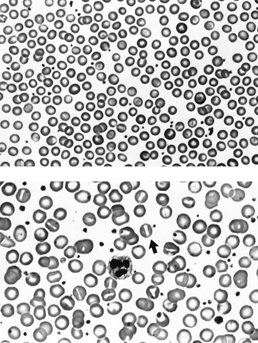 Fig. 3. RBC morphology. (Top) RBCs from a 7.2b knock-out mouse. (Bottom) RBCs from a human hereditary stomatocytosis patient. A typical stomatocyte is indicated by the arrow. Note the absence of stomatocytes in the 7.2b knock-out mouse sample. Original magnification × 500.