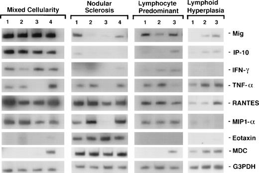 Fig. 1. Patterns of cytokine and chemokine mRNA expression in HD tissues shown by RT-PCR analysis. Total cellular RNA, extracted from paraffin-embedded tissues representative of HD MC, NS, NLP, and of lymphoid hyperplasia, was subjected to RT-PCR analysis using appropriately designed primers.