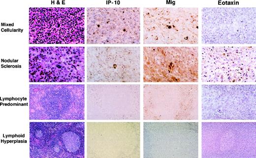 Fig. 4. Immunohistochemical analysis of IP-10, Mig, and eotaxin protein expression in HD tissues: MC, NS, and NLP, and lymphoid hyperplasia. Paraffin-embedded tissue sections were stained with hematoxylin and eosin (H&E), an anti-IP–10 heteroantiserum (IP-10), an anti-Mig heteroantiserum (Mig), and an antieotaxin heteroantiserum (eotaxin). Primary antibodies were detected with biotinylated antirabbit IgG, followed by streptavidin-peroxidase complexes.