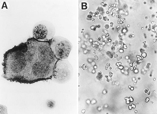 Fig. 2. Development of Mk generation from CB CD34+cells by sIL-6R, IL-6, and SCF. (A) A typical Mk generated in serum-free suspension culture was positively immunostained with anti-IIbIIIa MoAb by APAAP technique. Magnification: ×1000. (B) A representative Mk colony derived from CD34+ cells in serum-free methylcellulose culture (original magnification ×100).