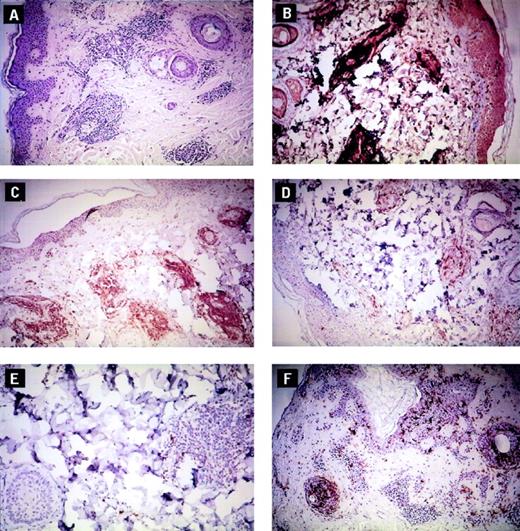 Fig. 1. The rhGM-CSF–specific DTH response is a predominant T-cell (CD3+) infiltrate with mixed CD4+and CD8+ lymphocytes. (A) Hematoxylin and eosin staining of the rhGM-CSF–induced dermal cellular infiltrate (30x). (B through F) Represents the immunohistochemical staining of the rhGM-CSF DTH site for patient CR4723. (B) CD3 (30x); (C) CD4 (30x); (D) CD8 (30x); (E) CD20 (40x); (F) CD1a (30x).