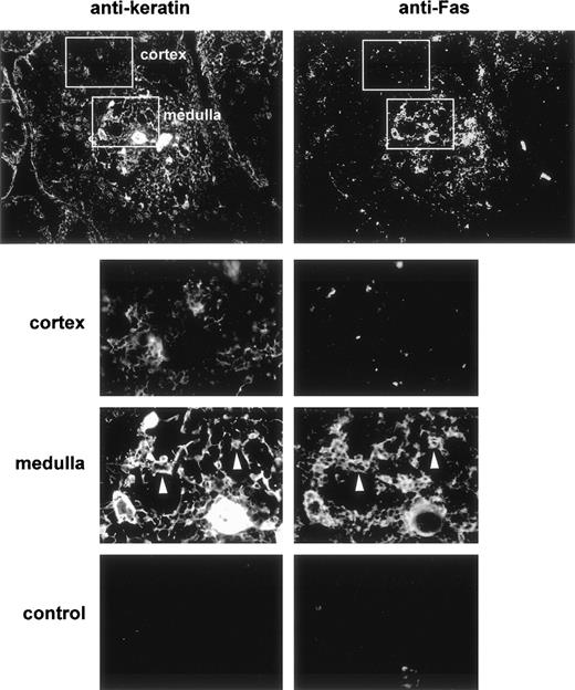 Fig. 1. Double immunofluorescence distribution of Fas and keratin in the human thymus. Frozen thymus sections were fixed in acetone and then double-stained with antikeratin (left) and anti-Fas (right) antibodies. After three washes they were stained with rhodamine-coupled antirabbit and FITC-coupled antimouse antibodies. The top plates (×10) show that Fas expression is mainly observed in the medullary area of the human thymus. Control sections (×20) were incubated with the fluorescent conjugates only. The lower plates are enlargements of the framed areas in the upper plates. The white arrows indicate medullary epithelial cells expressing keratin and Fas antigen.