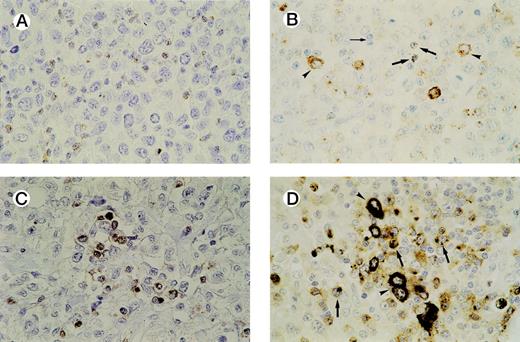 Fig. 3. Detection of activated CTLs. (A) Biopsy specimen of an ALCL patient with ≥ 15% activated CTLs, presenting with stage 1 disease who died 13 months later as a result of the disease. Brown cytoplasmic staining indicates GrB expression. Tumor cells are negative for GrB. (B) Biopsy specimen of an ALCL patient with a cytotoxic phenotype of the tumor cells and ≥ 15% activated CTLs. Both GrB+ tumor cells (arrowheads) and activated CTLs (thick arrows) show brown cytoplasmic staining; thin arrow indicates GrB− reactive lymphocytes. (C) Double-staining for CD8 and GrB in a biopsy specimen of an ALCL patient. The majority of activated CTLs express both CD8 (brown membranous staining) and GrB (black cytoplasmic staining). Tumor cells are CD8− and GrB−. (D) Double-staining for CD8 and GrB in a biopsy specimen of an ALCL patient with cytotoxic phenotype of the tumor cells. Tumor cells (arrowheads) show expression of GrB (black cytoplasmic staining), but not CD8, whereas activated CTLs (thick arrows) show expression of both GrB (black cytoplasmic staining) and CD8 (brown membranous staining).