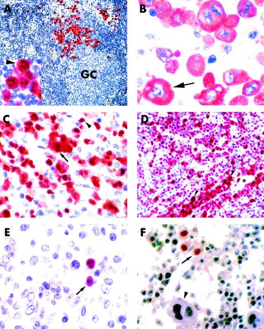 Fig. 1. ALK+ lymphoma, common type (lymph node, paraffin section). (A) Scattered ALK+ anaplastic tumor cells (labeled in red) are present in the paracortical area. Residual lymphoid tissue is ALK−. GC indicates a germinal center (×150). (Inset) Higher magnification (×800) of the same case showing cytoplasmic and nucleolar positivity of tumor cells for the ALK protein (arrowhead). (B) ALK+ lymphoma, common type (lymph node, paraffin section). Large anaplastic tumor cells show cytoplasm-restricted positivity for the ALK protein (arrow; ×800). (C) ALK+ lymphoma, common type (lymph node, paraffin section). Tumor cells consists of a mixture of large anaplastic elements expressing the ALK protein both in the nucleus and cytoplasm (arrow) and small tumor cells showing nucleus-restricted ALK positivity (arrowhead; ×800). (D) ALK+ lymphoma, small cell variant (lymph node, paraffin section). The tumor cell population mostly consists of small neoplastic elements showing nucleus-restricted ALK-positivity. A small percentage of large neoplastic cells that express the ALK protein both in the nucleus and cytoplasm (arrowheads) is present around blood vessels (*; ×500). (E and F) ALK+ lymphomas (paraffin sections). Rare small-size tumor cells showing nuclear-restricted ALK-positivity are detectable in the cortical area of the lymph node (E, arrow) and in the bone marrow (F, arrow). The arrowhead in (F) indicates an ALK−megakaryocyte (both ×800). (A through F) Immunostaining with the ALKc MoAb; APAAP technique.