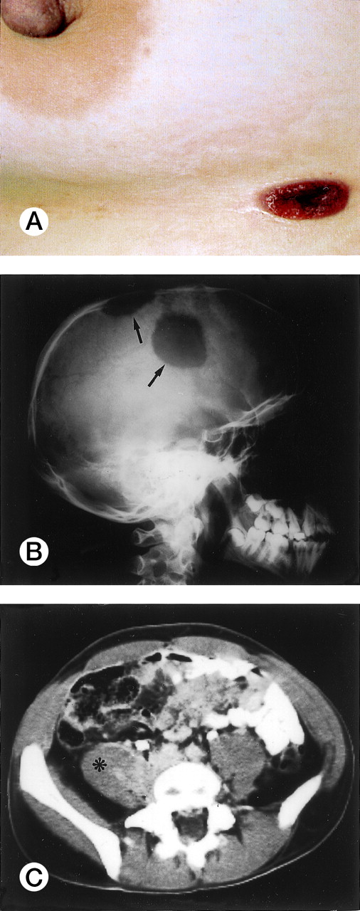 Fig. 3. Extranodal involvement in ALK+ lymphoma. (A) Umbelicated skin lesion in a 38-year-old women. (B) Large ostelytic lesions of the skull (arrows) in a 14-year-old boy. (C) Involvement of the right psoas muscle (asterix) in a 25-year-old man.