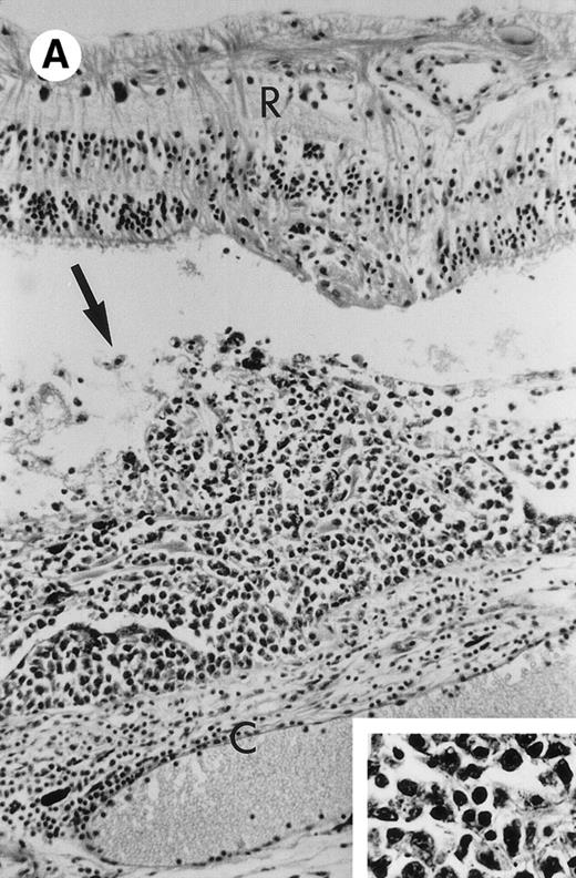 Fig. 1. Microphotograph showing typical intraocular lymphoma (arrow) in the subretinal space (A; case no. 8; insert, higher magnification of the lymphoma cells; R, retina; C, choroid) and a vitrectomy specimen (B; case no. 7; arrowheads, normal lymphocytes). (Original magnifications: A, hematoxylin & eosin, ×200, insert, ×400; B, Diff-Quick, ×400.)