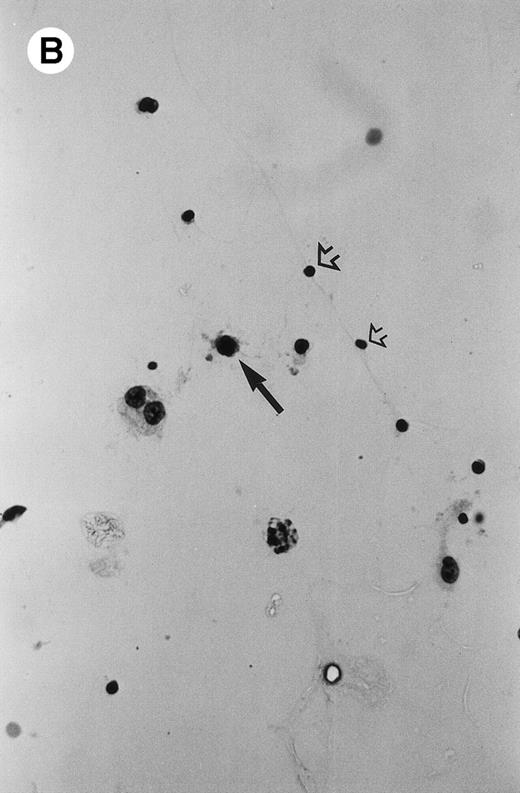 Fig. 1. Microphotograph showing typical intraocular lymphoma (arrow) in the subretinal space (A; case no. 8; insert, higher magnification of the lymphoma cells; R, retina; C, choroid) and a vitrectomy specimen (B; case no. 7; arrowheads, normal lymphocytes). (Original magnifications: A, hematoxylin & eosin, ×200, insert, ×400; B, Diff-Quick, ×400.)