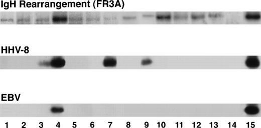 Fig. 2. PCR amplification showing rearrangement of third framework region in the VH region of heavy chain Ig gene in the lymphoma cells of all 13 cases, HHV-8 genome in 4 cases (lanes 3 and 4, AIDS patients; lanes 7 and 9, non-AIDS patients), and EBV genome in 1 case (lane 4, AIDS with lymphoma involving the orbit and eye). Lanes 1 through 13, cases no. 1 through 13, respectively; lane 14, negative control; lane 15, positive control.