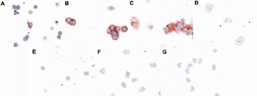 Fig. 4. Altered localization of p27 in differentiating myeloid cells. CD34+ cells were differentiated for 0 (A, E), 6 (B), 9 (C, F), or 15 (D, G) days and aliquots taken at various intervals for p27 immunostaining by using peroxidase detection. Cytospins shown have been indirectly stained either with isotype control (E-F) or anti-p27 antibody (Neomarkers Ab-1; A-D). Altered patterns of p27 immunoreactivity are evident.