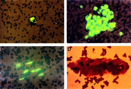 Fig. 2. Cytological analysis of CECs isolated with magnetic beads coated with S-Endo 1 antibody. Each panel shows CECs isolated from donors with AMI or UA. Panels A, B, and C show CECs stained with acridin orange presenting a round shape, clear nuclei and nucleoli (arrows) (A and B) or a spindle shape (C). Panel D shows a cell sheet stained with May-GrünwaldGiemsa. Numerous beads (focus or out of focus) are evident in all panels (arrowheads); they have a diameter of 4.5 μm.