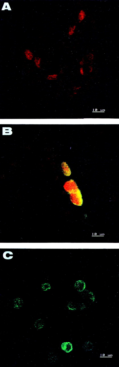 Fig. 4. Detection of apoptotic cells with TUNEL assay. (A and B) CECs isolated from donors with AMI or UA. (C) Control apoptotic HL60 cells. Nuclei of CECs are counterstained red with propidium iodide. A large majority of CECs including endothelial sheets are negative (A). Only rare cells show DNA breaks (B). The control apoptotic HL60 cells are positive (C).