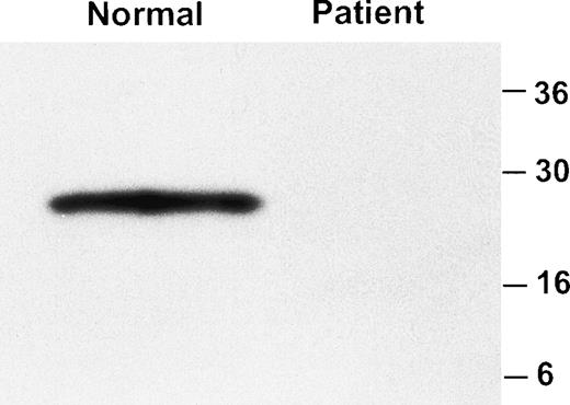 Fig. 2. Western blot analysis of GPIbβ in platelet lysate. Platelet lysate from a normal individual and the patient were analyzed by immunoblotting with an anti-GPIbβ polyclonal antibody. GPIbβ is readily detectable in the normal control and is absent in the patient.