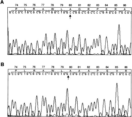 Fig. 3. Mutation within GPIbβ. DNA sequence analysis of GPIbβ from a normal individual (A) and the patient (B). Sequence analysis of PCR-amplified DNA showed that either nucleotide 336 or 337 was deleted.