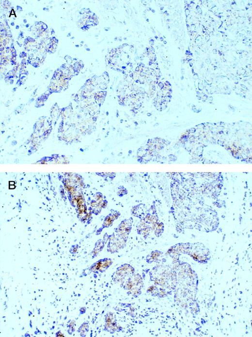 Fig. 2. Expression of CD40 on vitually all tumor cells in a case of ductal carcinoma. Lower magnification (bottom) demonstrated that CD40 can also be observed in smaller infiltrating lymphocytes. Original magnification: top, ×400; bottom, ×200.