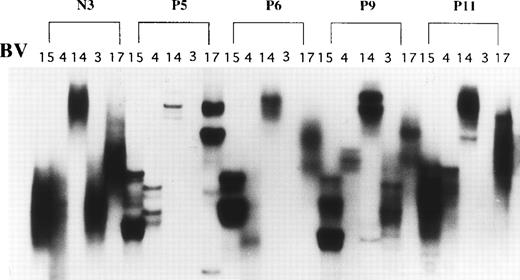 Fig. 4. SSCP analysis of TCR BV cDNA derived from BM of AA patients. Amplified BV cDNA from a normal individual (N3, normal no. 3), P5 (patient no. 5), P6, P9, and P11 was subjected to SSCP analysis.