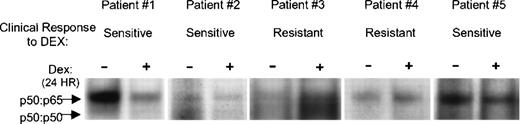 Fig. 8. Dex-mediated downregulation of NF-κB DNA binding activity correlates with patients’ clinical response to Dex. FACS-sorted–purified myeloma plasma cells from bone marrow aspirates of MM patients were treated with and without Dex (0.1 μmol/L) for 24 hours. WCEs were prepared and subjected to EMSA for binding to the κB oligonucleotide probe.