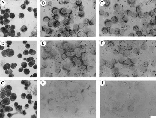 Fig. 7. Enriched bone marrow plasma cells isolated from patients with (A) active (relapsing) MM, (D) nonactive (plateau) MM, and (G) MGUS stained with May-Grünwald-Giemsa. Expression of (B) MMP-2 and (C) MMP-9 mRNA by the plasma cells of the active MM patient; (E) MMP-2 and (F) MMP-9 mRNA by those of the nonactive MM patient; (H) MMP-2 mRNA by those of the MGUS patient; (I) MMP-2 mRNA by a control subject (a patient with pernicious anemia). Note the weaker MMP-2 expression in the nonactive MM patient, a weak expression in the MGUS patient, and no expression in the control. Bar, 22 μm in (A), (D), (G); 16 μm in (B), (C), (E), (F), (H), and (I).