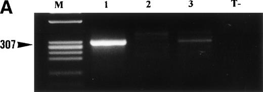 Fig. 4. (A) RT-PCR analysis of TPM3-ALK RNA in 3 cases of ALCL showing ALK-staining restricted to the cytoplasm. RNA obtained from the SU-DHL-1 cell line was used as negative control (T−). RT-PCR was performed using two rounds of PCR. The first round involved C-TPM1 and ALK-1 primers, and the second was a nested amplification using C-TPM3 and ALK-2 primers. PCR products were electrophoresed on 2% agarose gel and visualized with ethidium bromide staining. Two of these three cases of ALCL (cases no. 1 and 3) show a band of 307 bp, indicating the presence of hybrid TPM3-ALK RNA. M, size marker. (B) Nucleotide sequence of hybrid TPM3-ALK transcripts detected by nested RT-PCR using C-TPM3 and ALK2 primers. Nucleotides are numbered from the deoxyadenosine residue of the TPM3 initiator ATG codon.