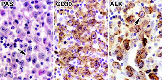 Fig. 3. Immunomorphologic features of the ALCL (GEL) carrying the (1;2) translocation. The morphology in a PAS-stained section is typical of the common-type of ALCL, and a hallmark cell,6 with an eccentric horseshoe-shaped nuclei, is arrowed. Staining for CD30 shows typical cytoplasmic and membrane-associated labeling of malignant cells. Labeling for ALK protein (antibody ALK1) is confined to the cell cytoplasm.