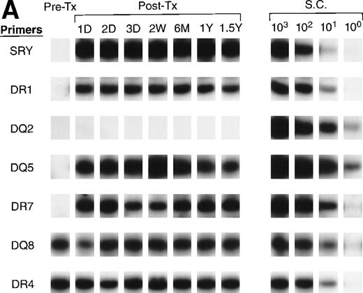 Fig. 7. QAS-PCR results of HLA DR and DQ amplification for samples collected from recipients B (A) and D (B). Pre-tx and serial post-tx samples collected from female trauma tx recipients B and D were amplified with a panel of primer pairs specific to HLA DR (1, 2, 4, 7) and DQ (2, 4, 5, 6, 7, 8) and hybridized with specific probes. The results of DR2 and DQ6 were positive and DQ4 and DQ7 negative at all time points, and are not shown for recipient B; the results of DR1, DR2, DQ4, DQ5, and DQ7 were negative at all time points and are not shown for recipient D.