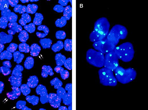 Fig. 1. Immunolabeling of a microgranular APL case (A) and of an acute nonlymphoid leukemia M4 subtype (B) with the PG-M3 MoAb. (A) Indirect immunofluorescence with rhodamine-labeled antibody and nuclear DAPI counterstain. Double arrows show a microspeckled distribution of the PML/RAR protein within the nuclei of APL cells. This pattern contrasts with the nuclear speckled positivity PML wild type of normal residual hematopoietic elements (single arrow). (B) Indirect immunofluorescence with fluoresceine-labeled antibody and nuclear DAPI counterstain. Blast cells show the nuclear speckled positivity.