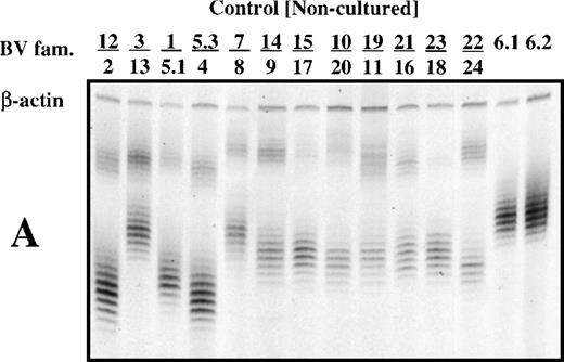 Fig. 1. T-cell receptor spectratype analysis (multiplex PCR) of 26 BV families using noncultured PBMC from a normal subject (A) and from patients 1 and 2 (B and C). Primers specific for β-actin were included in each reaction mixture as a check on fidelity. Bands in each group differ from each other by 3 bp in length because only T cells with productive (in phase) VDJ rearrangements are found in the peripheral blood.