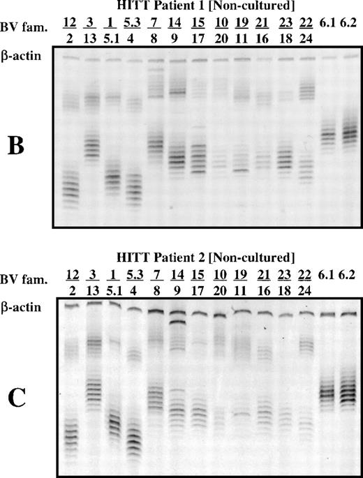 Fig. 1. T-cell receptor spectratype analysis (multiplex PCR) of 26 BV families using noncultured PBMC from a normal subject (A) and from patients 1 and 2 (B and C). Primers specific for β-actin were included in each reaction mixture as a check on fidelity. Bands in each group differ from each other by 3 bp in length because only T cells with productive (in phase) VDJ rearrangements are found in the peripheral blood.