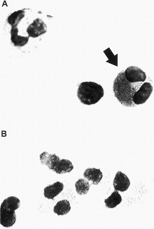 Fig. 1. Human eosinophil detected in a buffy coat cytospin. (A) The eosinophil was stained specifically with mouse monoclonal anti-human RANTES (20 μg/mL) using APAAP staining, as indicated by the arrow. Two unlabeled cells are also visible within this field, a neutrophil possessing a multilobed nucleus (upper left) and a lymphocyte (left of the stained eosinophil). (B) Isotype control using mouse IgG1 antibody (20 μg/mL). Original magnification × 100.