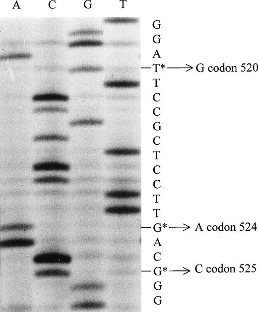 Fig. 2. This is a sequence gel of one of the cases of North American Hodgkin’s disease; this is the minus strand of the V-leu variant. This shows a change from thymine to guanine at codon 520, from guanine to alanine at codon 524, and from guanine to cytosine at codon 525.