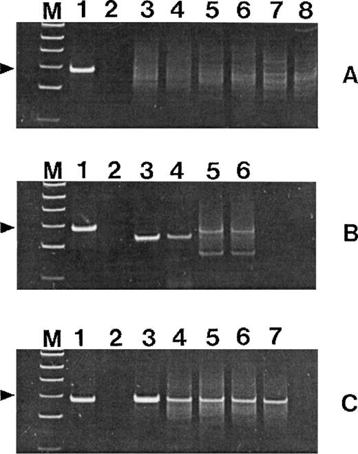 Fig. 1. Polyacrylamide gels of TCRγ (set 1) PCR products. Lanes M, ◊XHinfl molecular-weight markers (the 82-bp fragment is indicated); lanes 1, positive control T-cell lymphoma; lanes 2, negative control without template DNA. (A) Lanes 3, 4, and 5, 6, and 7, 8: duplicate amplifications of three cases of uncomplicated celiac disease. (B) Lanes 3, 4 and 5, 6: duplicate amplifications of two cases of nonresponsive celiac disease. (C) Lane 3, EATL tumor mass; lanes 4 through 7, nonlymphomatous mucosa.